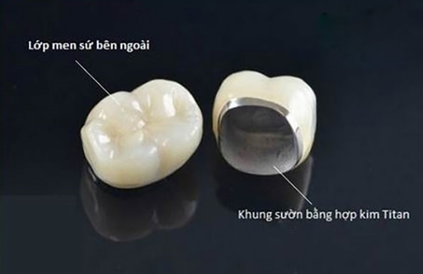Răng sứ titan có lớp ngoài hoàn toàn là sứ, lớp sườn bên trong là hợp kim Titan